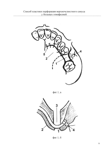 Способ пластики перфорации верхнечелюстного синуса у больных гемофилией (патент 2586456)