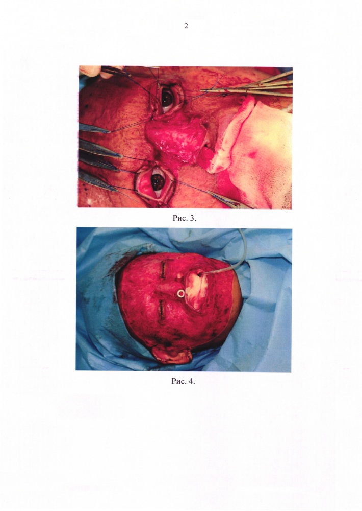 Способ хирургического лечения больных с тотальными рубцовыми деформациями лица (патент 2655832)