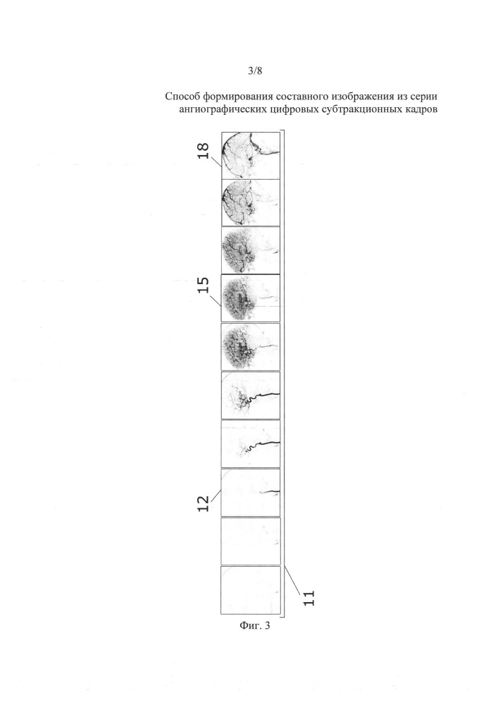 Способ формирования составного изображения из серии ангиографических цифровых субтракционных кадров (патент 2633949)