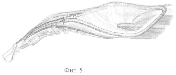 Способ восстановления активного разгибания межфаланговых суставов трехфаланговых пальцев кисти после реплантации (реваскуляризации) крупных сегментов верхней конечности (патент 2405483)