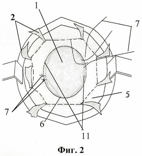 Способ пластики при больших послеоперационных вентральных грыжах (патент 2458640)