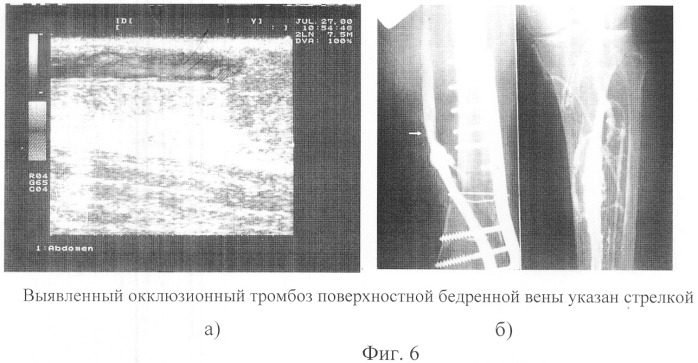 Способ оптико-электронной диагностики тромбоза глубоких вен голени (патент 2314026)