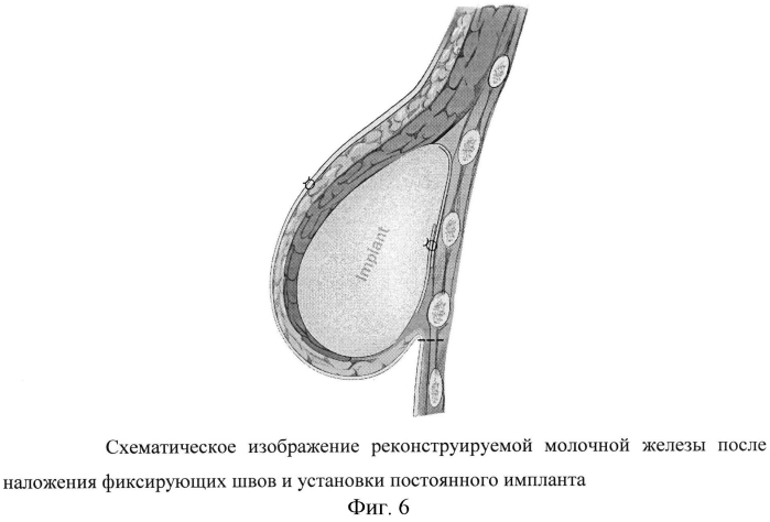 Способ формирования инфрамаммарной складки при двухэтапной реконструкции молочной железы (патент 2567790)