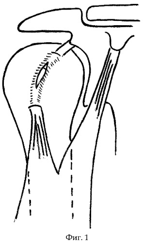 Способ оперативного лечения нестабильности плечевого сустава (патент 2412666)