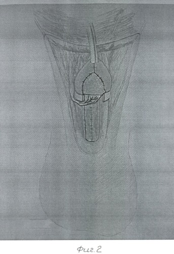 Способ хирургического лечения гипоспадии (патент 2371103)