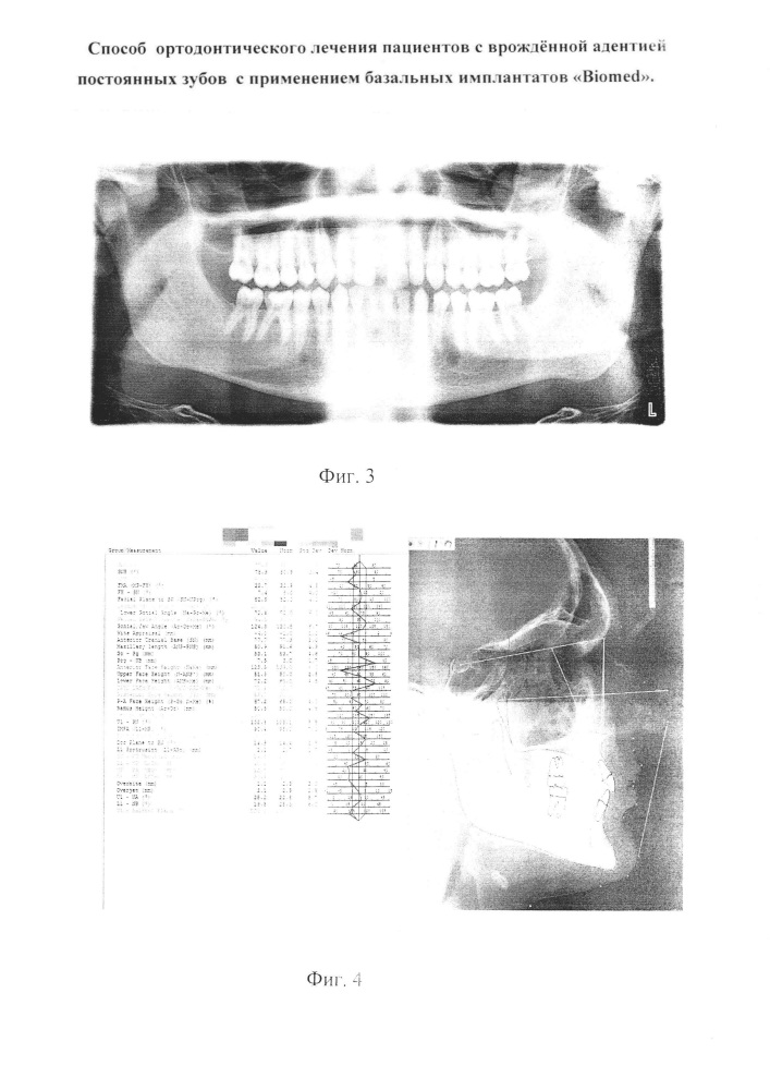 Способ ортодонтического лечения пациентов с врождённой адентией постоянных зубов с применением базальных имплантатов "biomed" (патент 2638286)