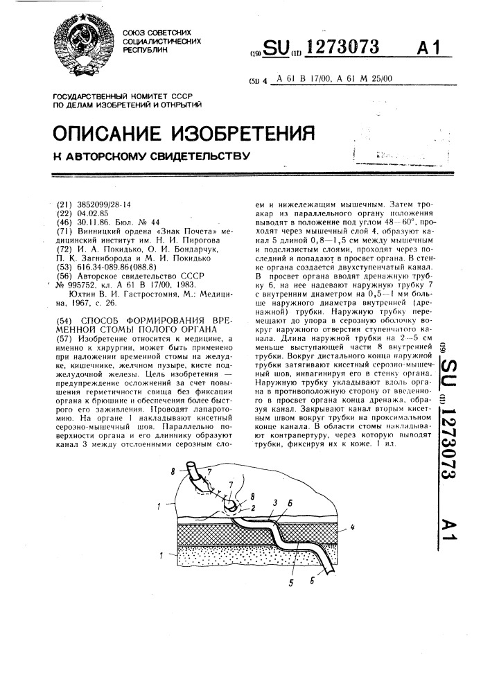 Способ формирования временной стомы полого органа (патент 1273073)