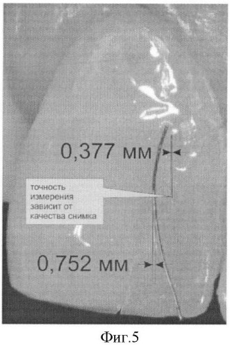 Способ комплексной оценки качества реставрации твердых тканей зуба (патент 2391935)