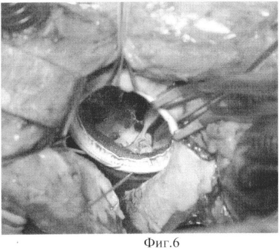 Способ имплантации механического протеза клапана сердца (патент 2454204)