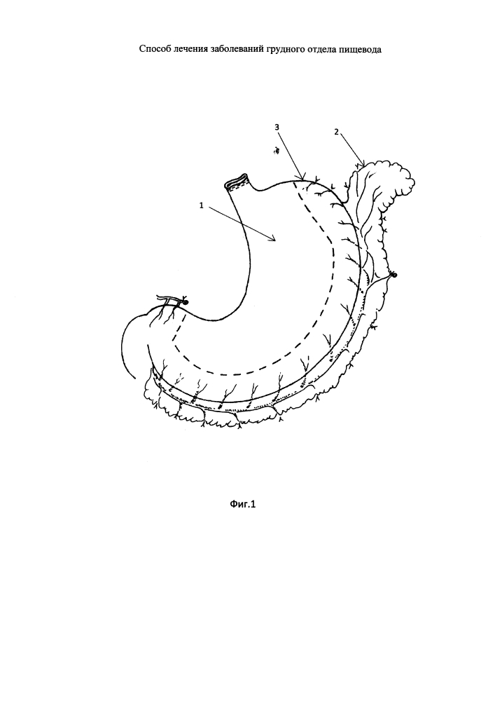 Способ лечения заболеваний грудного отдела пищевода (патент 2612098)