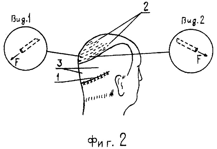 Способ трансплантации волос головы (патент 2295304)