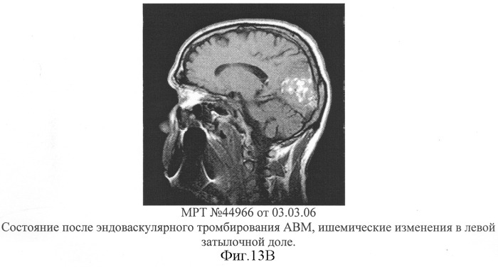 Способ эмболизации артериовенозных мальформаций головного мозга в условиях общей анестезии и управляемой гипотонии (патент 2315634)