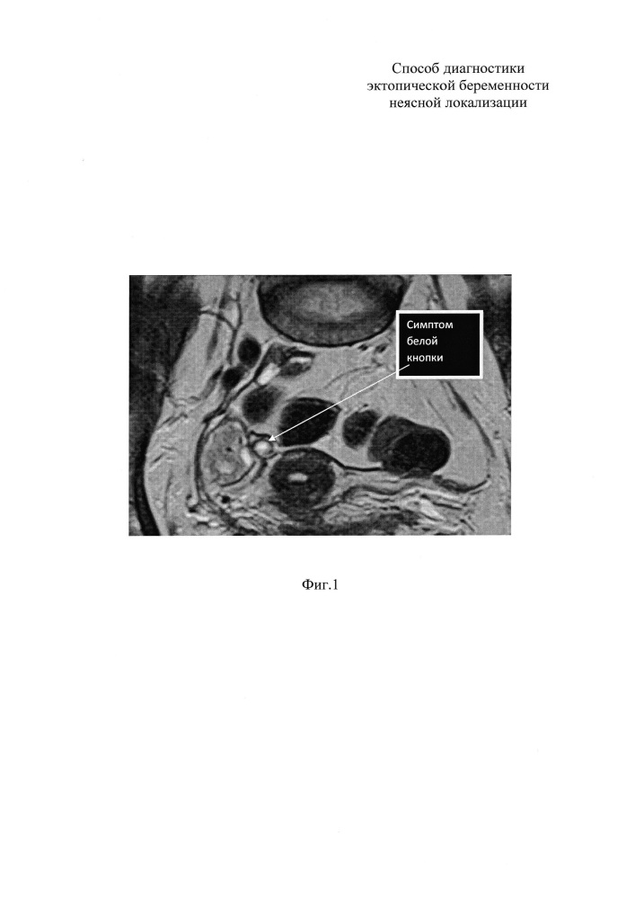 Способ диагностики эктопической беременности (патент 2638290)