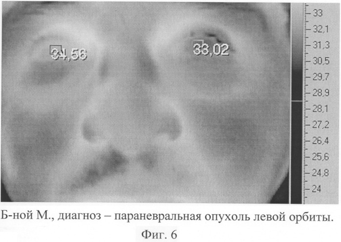 Способ диагностики ишемии зрительного нерва (патент 2299672)