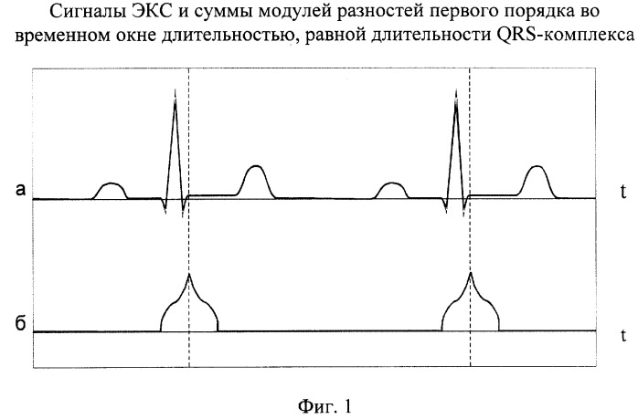 Способ выделения st-сегмента электрокардиосигнала в реальном времени и устройство для его осуществления (патент 2261653)