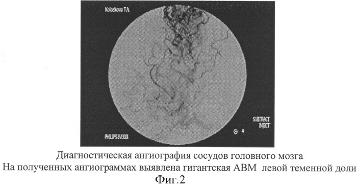 Способ эмболизации артериовенозных мальформаций головного мозга в условиях общей анестезии и управляемой гипотонии (патент 2315634)