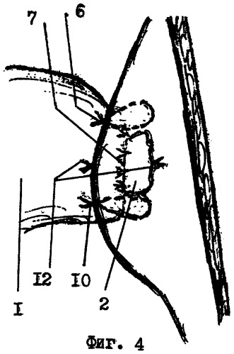 Способ ушивания культи двенадцатиперстной кишки (патент 2308238)