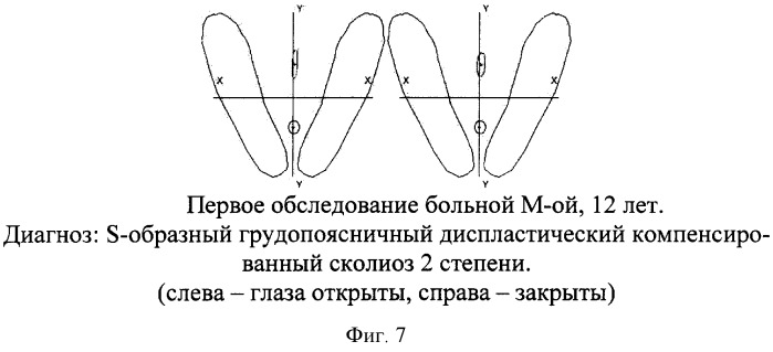 Способ прогнозирования прогрессирования сколиотической деформации (патент 2302818)