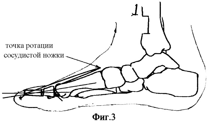 Способ восстановления первого пальца стопы при повреждениях и их последствиях (патент 2270628)