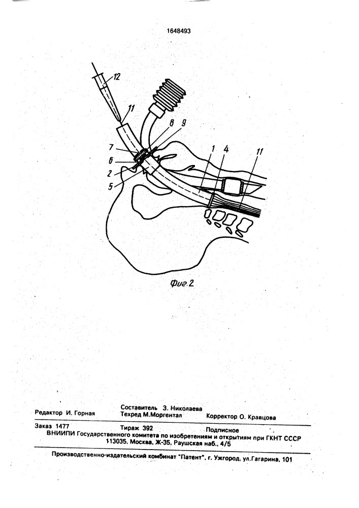 Устройство для проведения бужа в пищевод (патент 1648493)