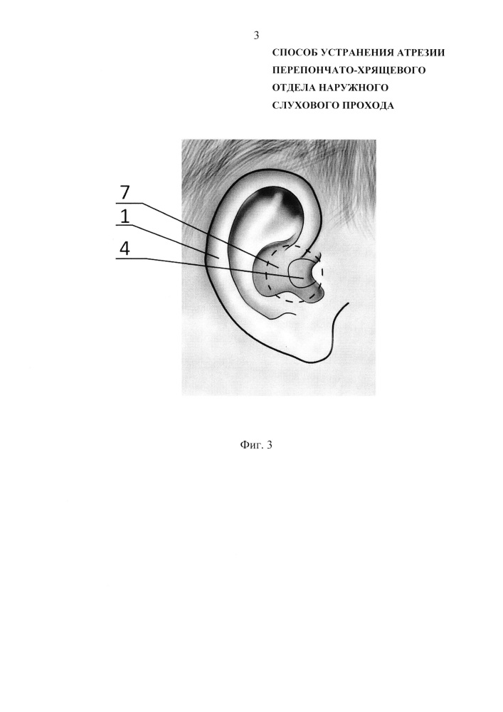 Способ устранения атрезии перепончато-хрящевого отдела наружного слухового прохода (патент 2621948)