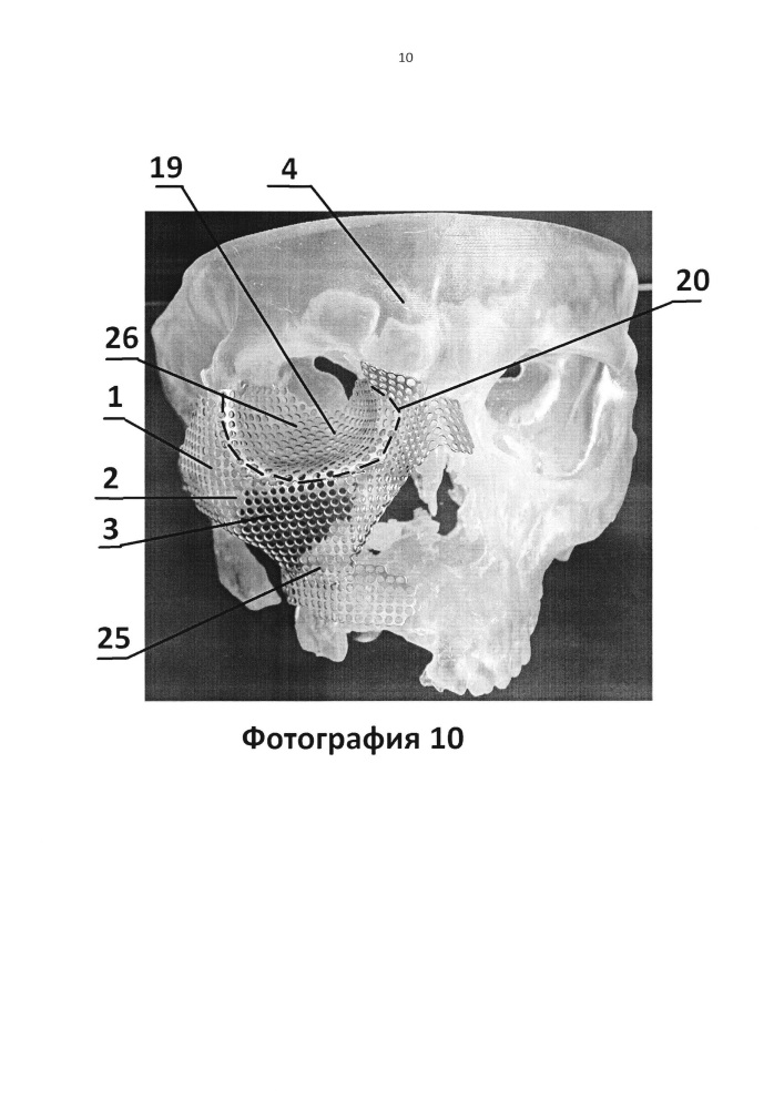 Имплантат для протезирования костей черепа и способ изготовления имплантата для протезирования костей черепа (патент 2638894)