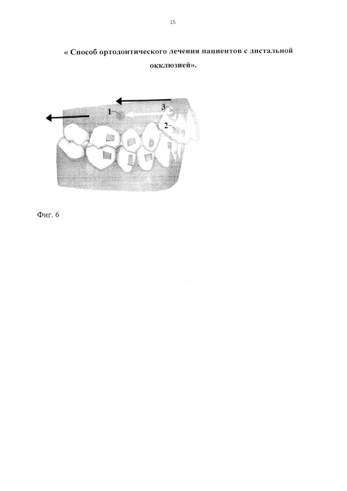 Способ ортодонтического лечения пациентов с дистальной окклюзией (патент 2648828)