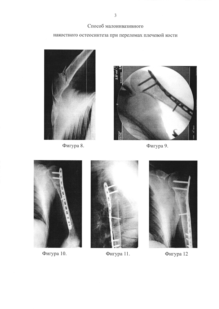 Способ малоинвазивного накостного остеосинтеза при переломах диафиза и хирургической шейки плечевой кости (патент 2594444)