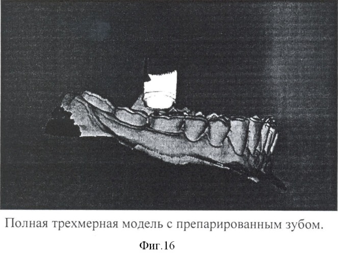 Способ воспроизведения зарегистрированных окклюзионных положений на компьютерных трехмерных моделях зубных рядов и ориентации компьютерных трехмерных моделей в пространстве (патент 2401083)