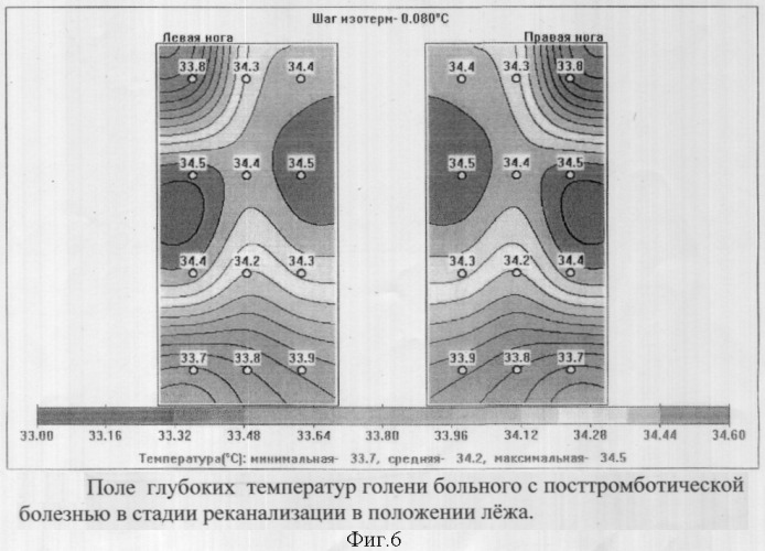 Способ комбинированной термометрии для диагностики посттромботической болезни вен нижних конечностей (патент 2319438)