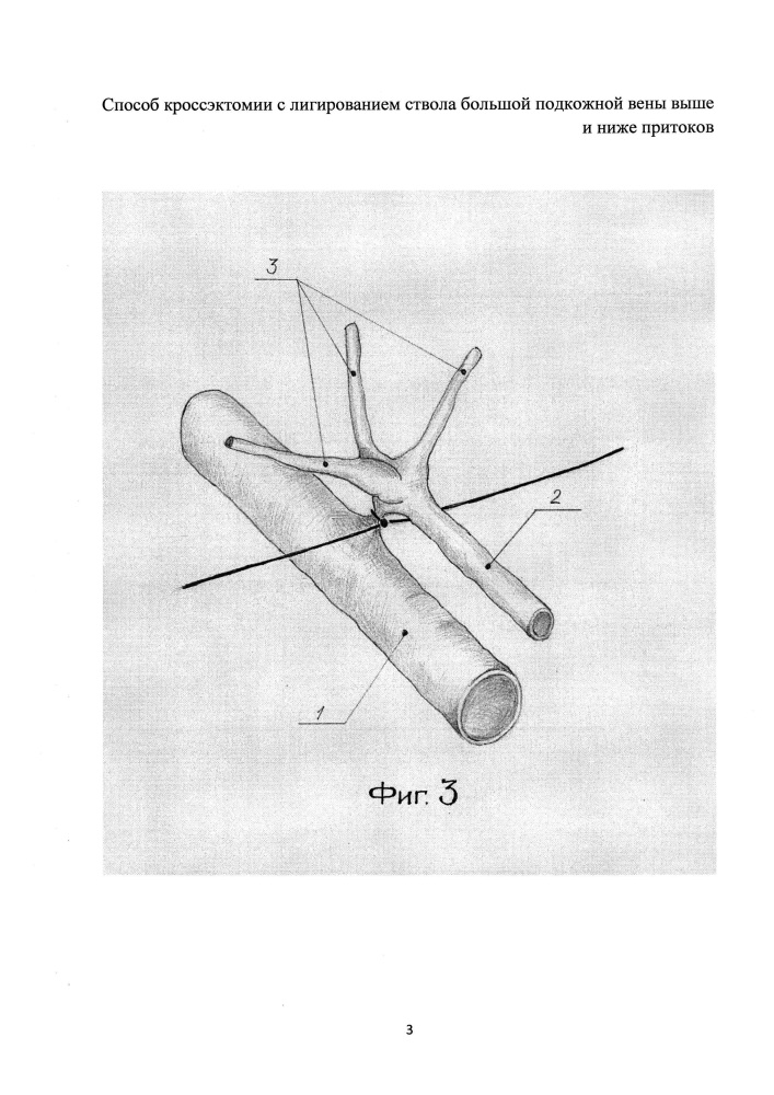 Способ кроссэктомии с лигированием ствола большой подкожной вены выше и ниже притоков (патент 2607919)