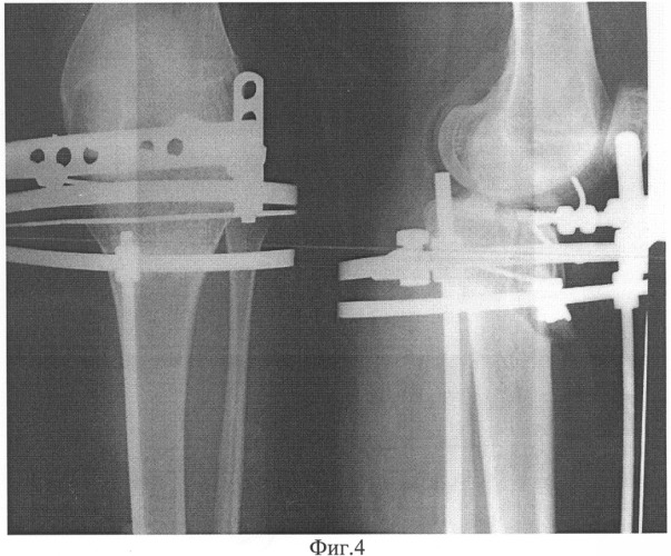 Способ внесуставной коррекции деформаций коленного сустава (патент 2316281)