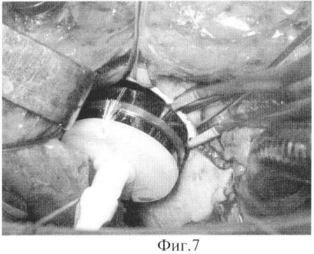 Способ имплантации механического протеза клапана сердца (патент 2454204)
