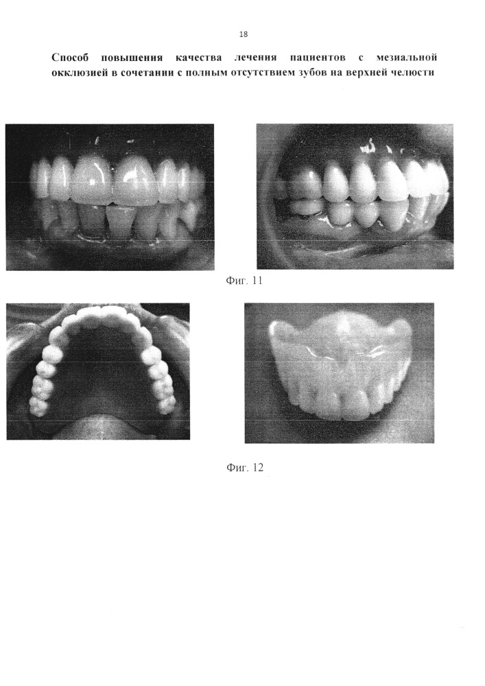 Способ повышения качества лечения пациентов с мезиальной окклюзией в сочетании с полным отсутствием зубов на верхней челюсти (патент 2658159)