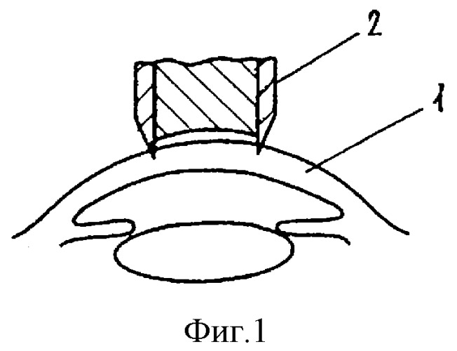 Метод фиксации аллопланта к роговице (патент 2308914)