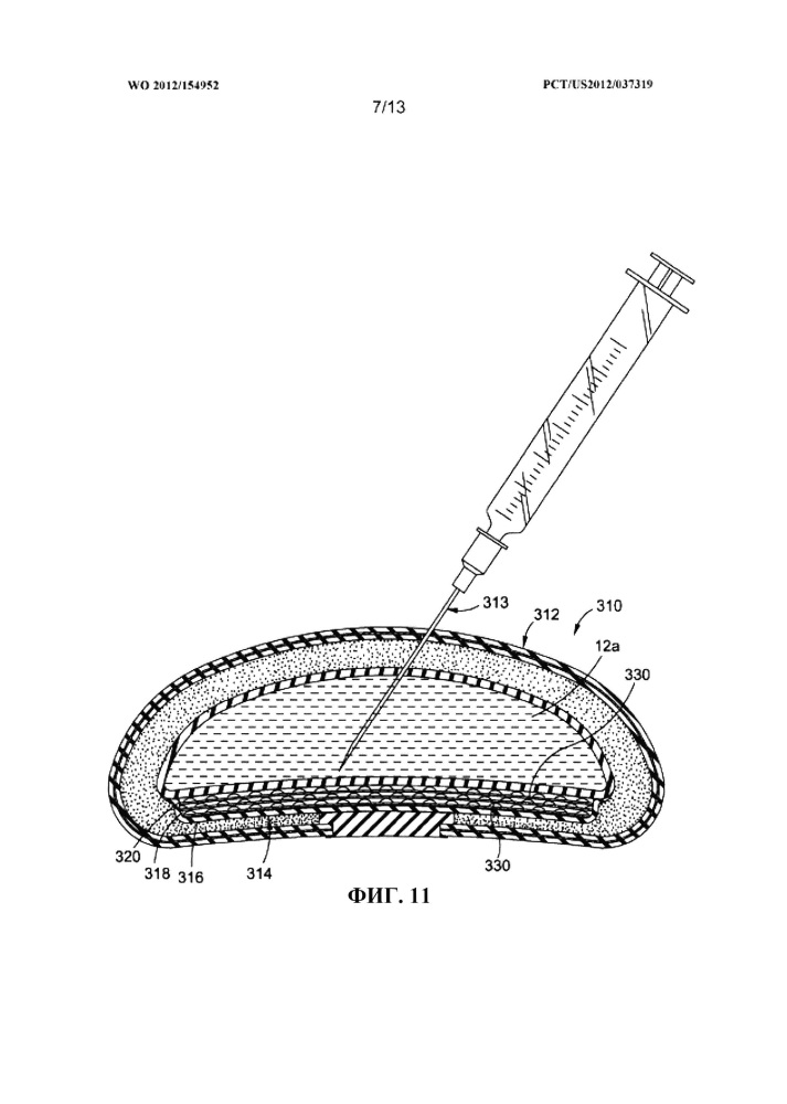 Заполняемые протезы и способы их изготовления (патент 2615372)