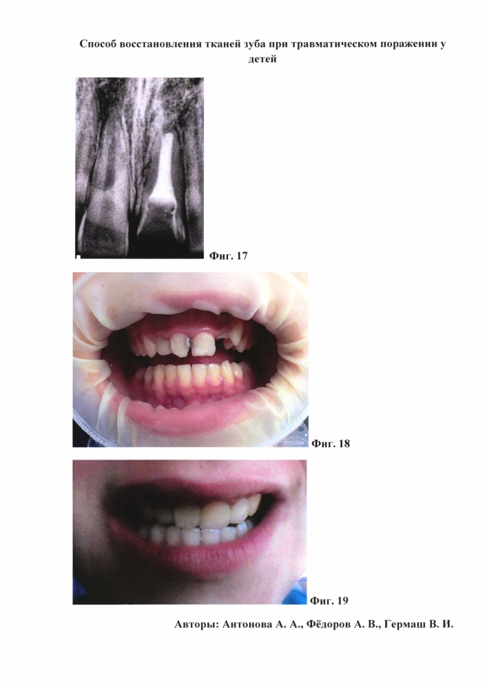 Способ восстановления тканей зуба при травматическом поражении у детей (патент 2604387)