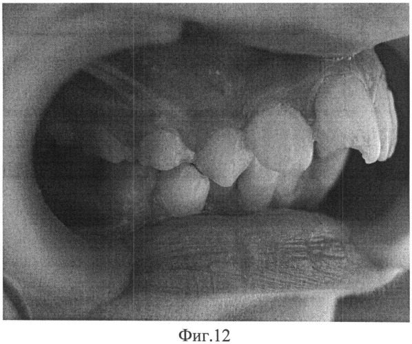 Способ диагностики зубочелюстной аномалии у детей (патент 2485893)