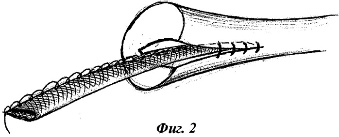 Способ протезирования сухожилий (патент 2340303)