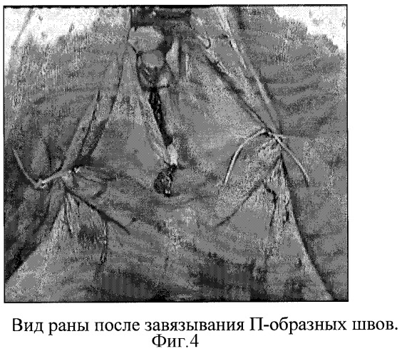 Способ хирургического лечения ректоцеле (патент 2283038)