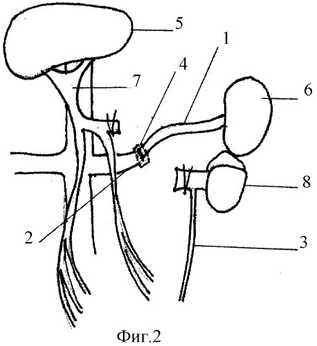 Способ лечения портальной гипертензии (патент 2321360)