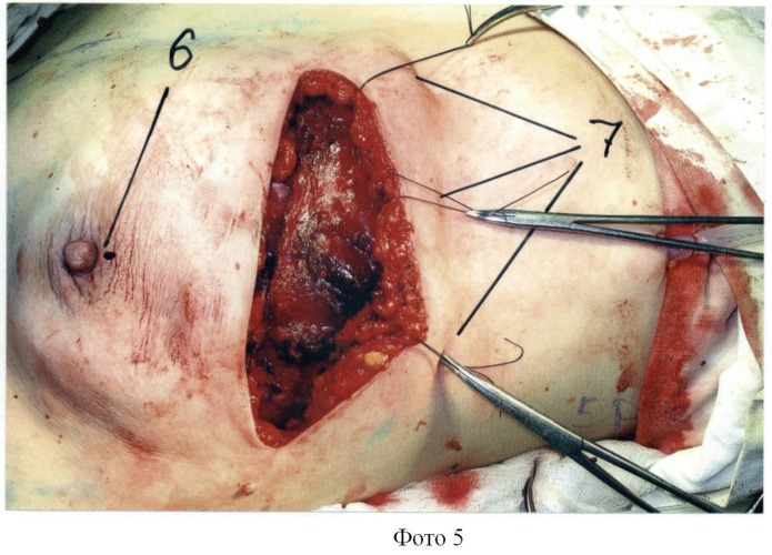 Способ хирургического лечения рака молочной железы (патент 2444303)