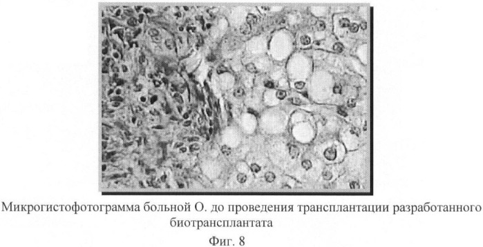 Биотрансплантат, способ лечения хронических заболеваний печени и способ лечения цирроза печени и портальной гипертензии (патент 2368384)