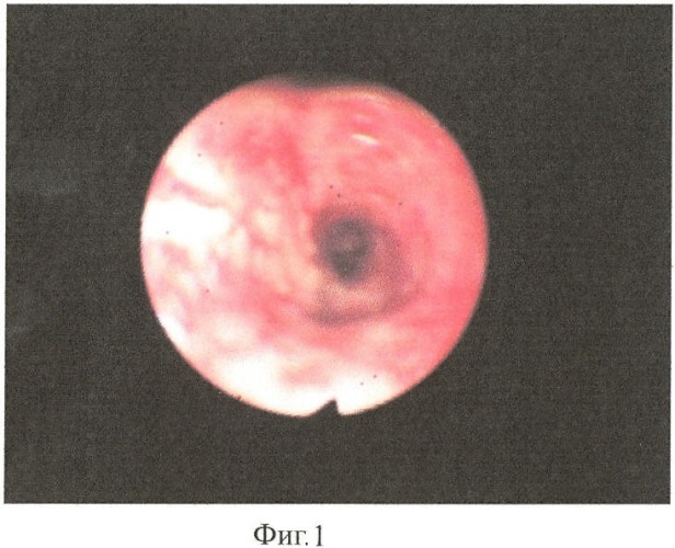 Способ прогнозирования стенозов трахеи после длительной интубации и трахеостомии (патент 2412445)