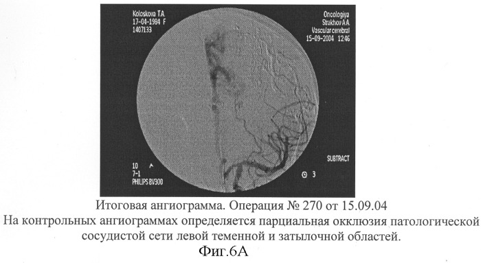 Способ эмболизации артериовенозных мальформаций головного мозга в условиях общей анестезии и управляемой гипотонии (патент 2315634)