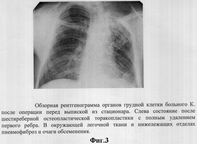 Способ лечения деструктивного туберкулеза легких (патент 2312616)