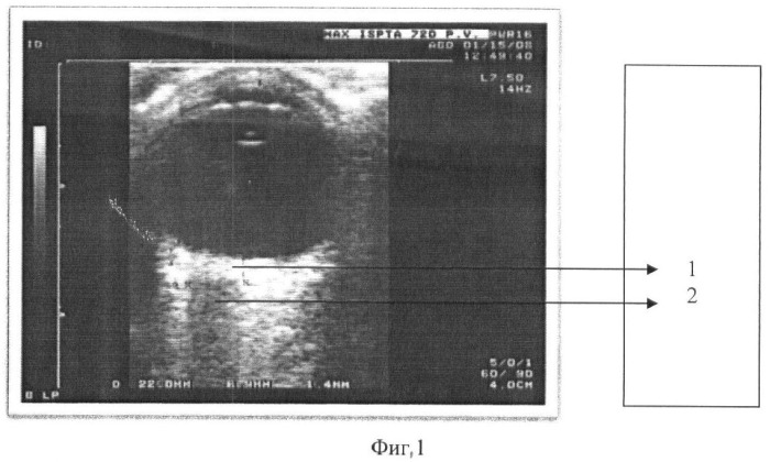 Способ прогнозирования отслойки сосудистой оболочки при операциях глаукомы с помощью ультразвуковых диагностических критериев (патент 2373860)