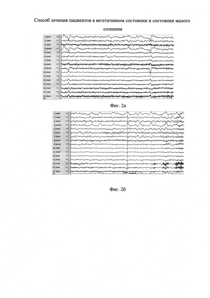 Способ лечения пациентов в вегетативном состоянии и состоянии малого сознания (патент 2612264)