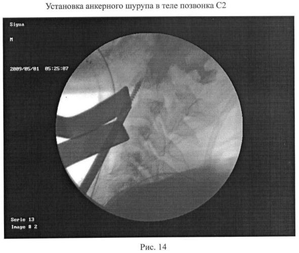 Способ анкерной коррекции и фиксации травматических дислокаций тела позвонка с2 при переломах палача (патент 2463978)