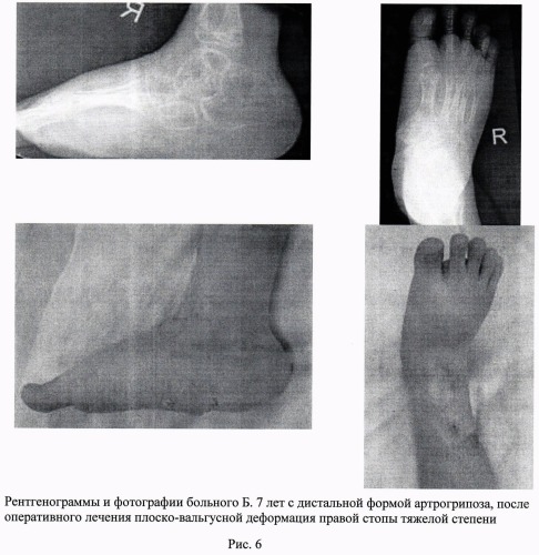 Способ лечения врожденной плоско-вальгусной деформации стоп тяжелой степени у детей с артрогрипозом (патент 2493793)